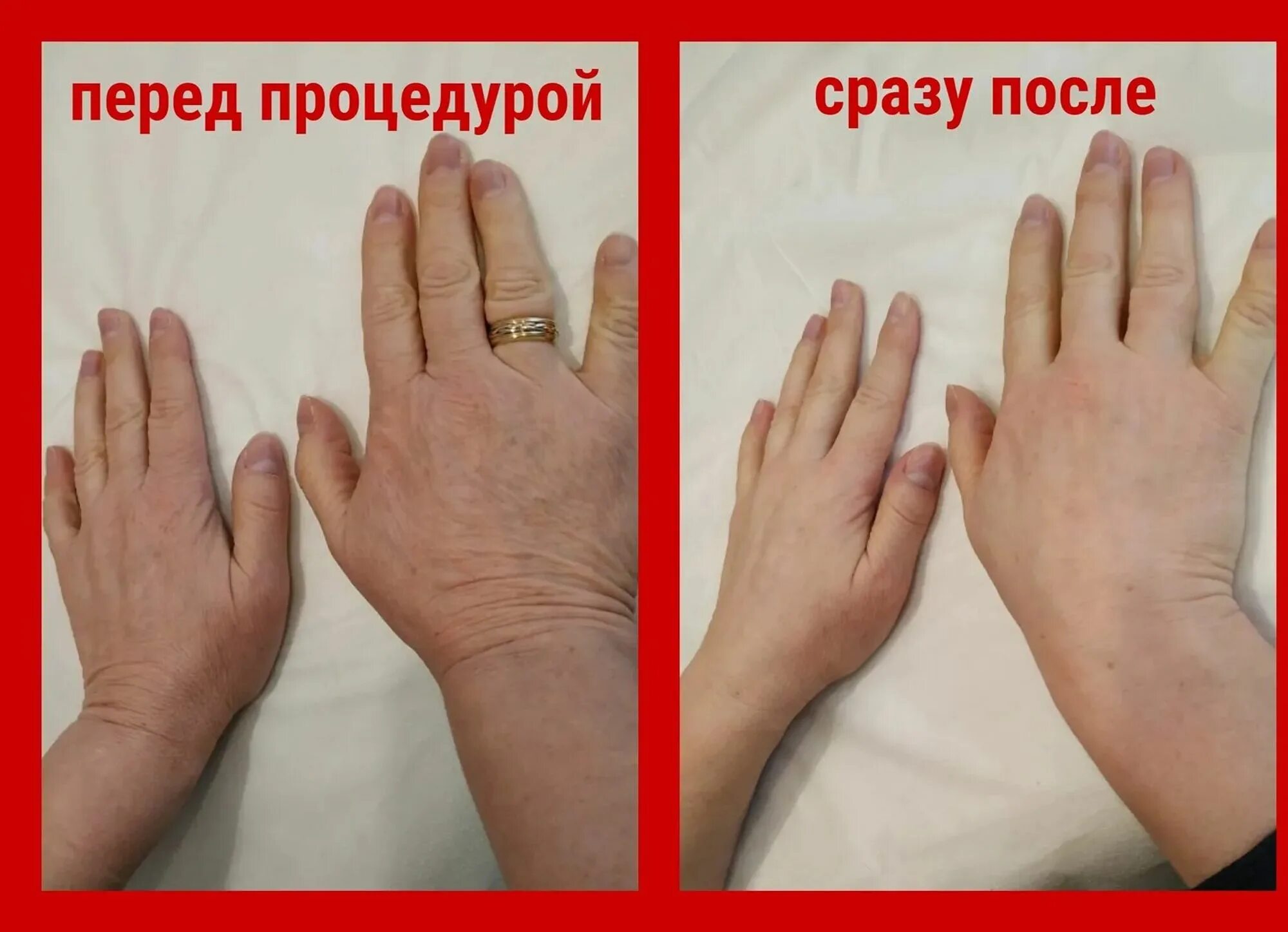 Плазмолифтинг кистей рук. Легкие руки отзывы. Биоревитализация кистей рук. Легкие руки отзывы. Плазмолифтинг для кожи рук.