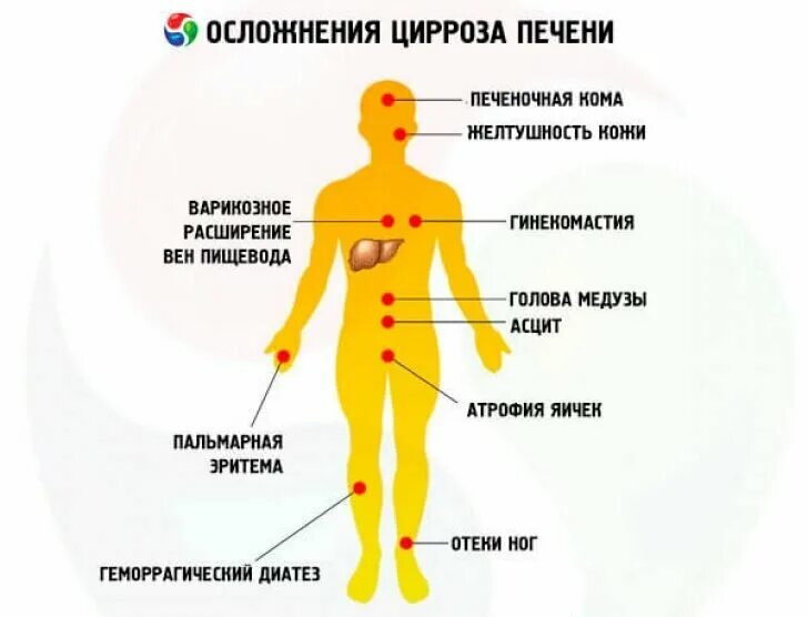 Цирроз первые признаки у женщин. Периферические признаки цирроза печени. Цирроз печени ранние симптомы. Признаки церроз печени. Цирроз печени признаки и симптомы.