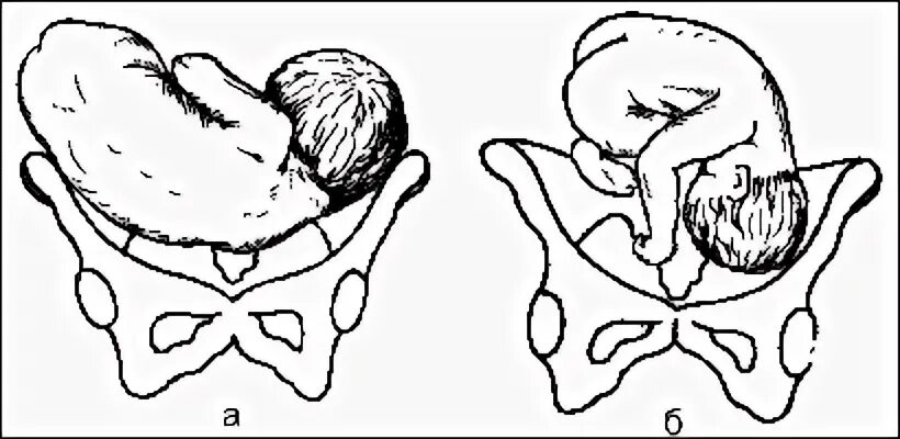 Косое предлежание плода на 30 неделе. Поперечное и косое предлежание плода. Поперечное предлежание плода на 30 неделе. Тазовое поперечное и косое предлежание плода.