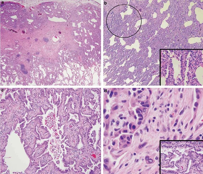 Низкодифференцированная аденокарцинома гистология. Высокодифференцированная аденокарцинома гистология. Гистология крупноацинарная аденокарцинома. Высокодифференцированная аденокарцинома эндометрия гистология. Низкодифференцированный плоскоклеточный рак
