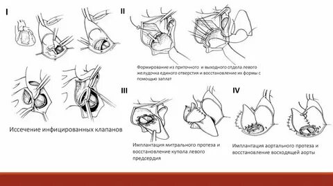 Операция левого