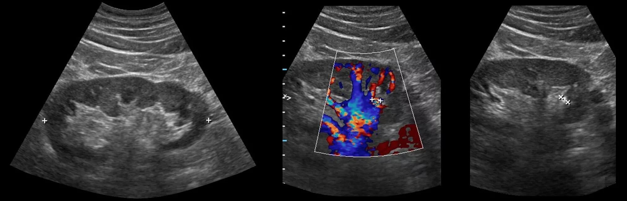 Узи почек диагнозы. Сонография хронический пиелонефрит. УЗИ почек хронический пиелонефрит. Почечная недостаточность на УЗИ. Конкременты в почках на УЗИ что это такое.