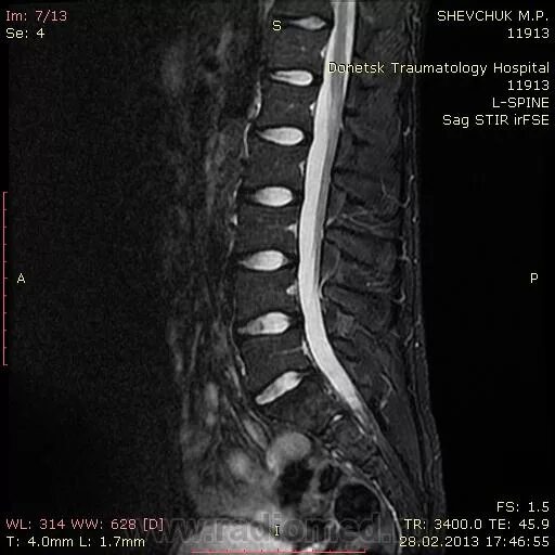 Мрт пояснично крестцового отдела позвоночника цена москва. Мрт пояснично-крестцового отдела. Мрт крестцового отдела. Снимок мрт поясничного отдела женское. Боль в пояснице мрт.