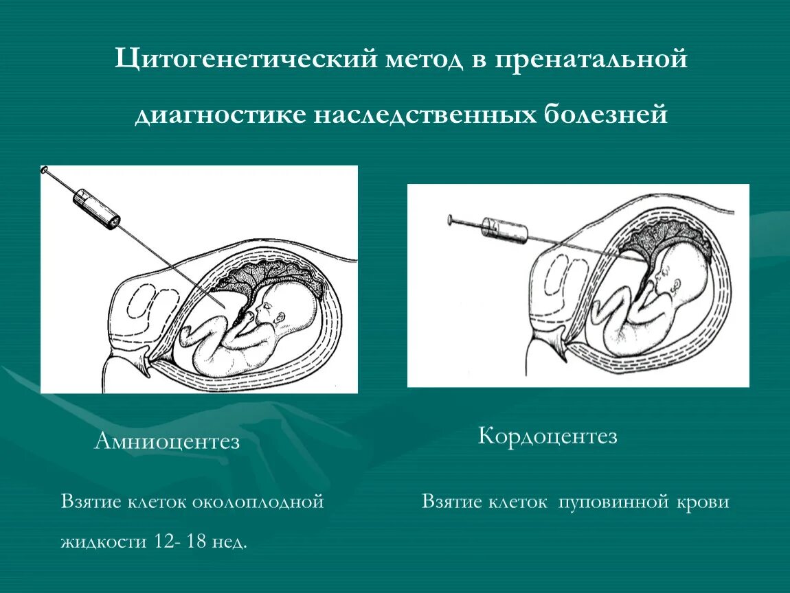 Методы пренатальной диагностики УЗИ амниоцентез биопсия хориона. Пренатальная диагностика наследственных заболеваний амниоцентез. Биопсия хориона амниоцентез кордоцентез. Метод пренатальной диагностики амниоцентез. Цитогенетический метод наследственные заболевания