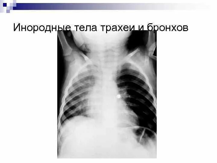 Инородные Тела Трахеи Бронхов