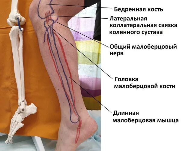 Малоберцовый нерв стопа. Малоберцовая мышца. Нерв малоберцовой кости. Нерв в малоберцовой кости общий. Головка малоберцовой кости и малоберцовый нерв.