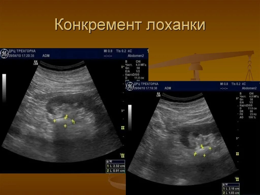 Делать лоханку. Конкремент лоханки почки. Конкременты в почечных лоханках.