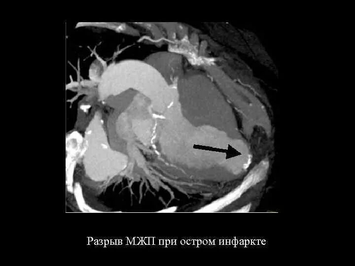 Эхокг инфаркт миокарда. Инфаркт миокарда межжелудочковой перегородки. Акинезия левого желудочка. Эхокг инфаркт миокарда. Инфаркт межжелудочковой перегородки экг.