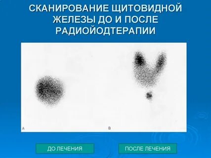 После радиойодтерапии щитовидной форум