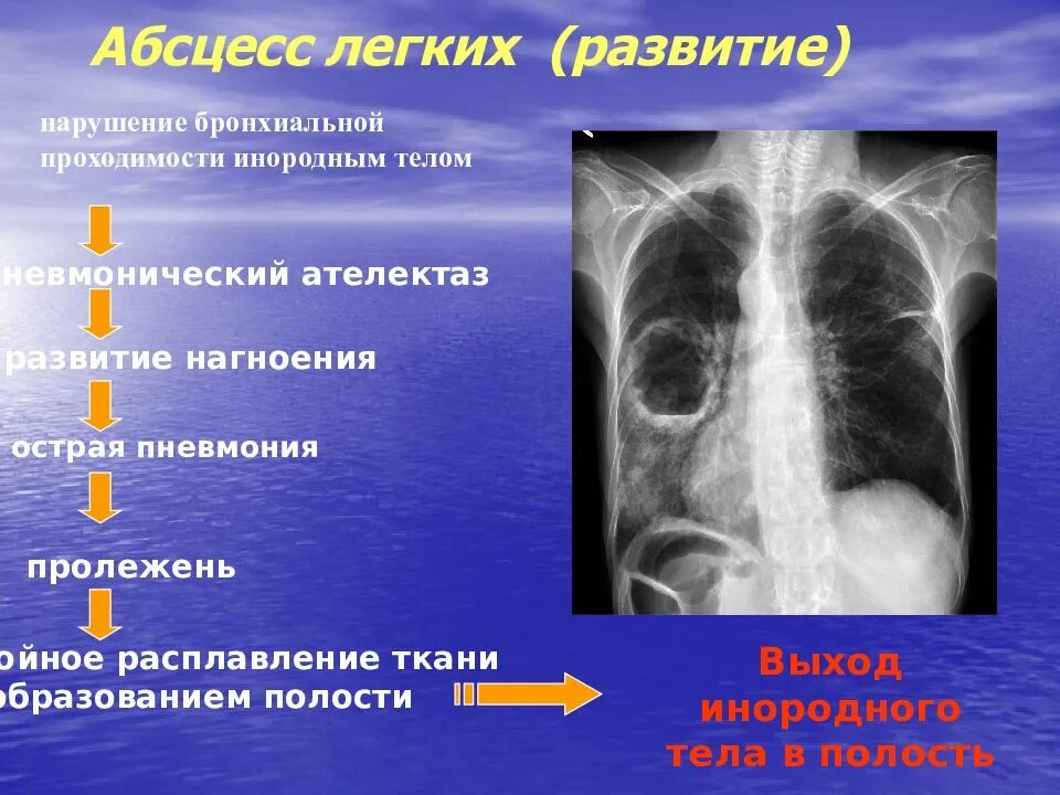 Для абсцесса легкого характерно. Синдромы при абсцессе легкого. Симптомы при абсцессе легкого. Клиническая картина абсцесса легкого. Абсцесс легкого причины.