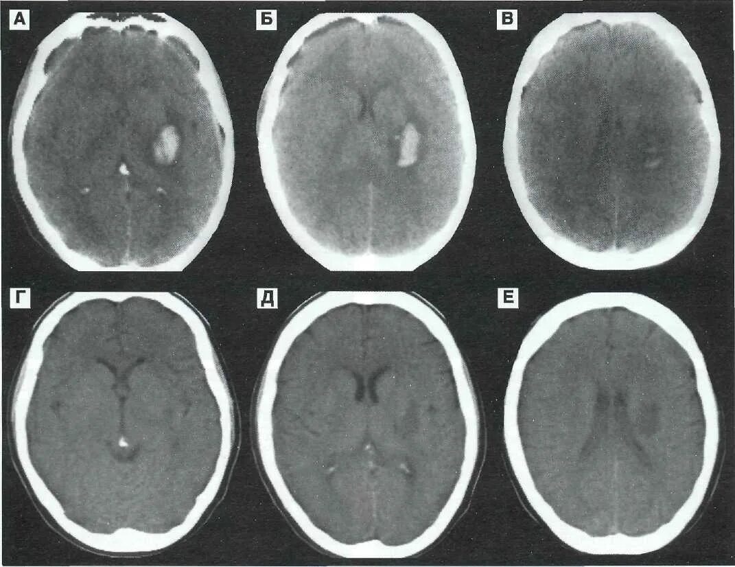 Отек мозга умирают. Диффузное аксональное повреждение мозга кт. Диффузно аксональные повреждения головного мозга кт. Контузионный очаг в головном мозге на кт.