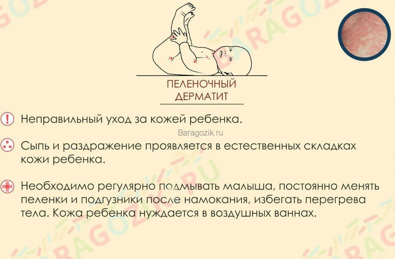 Почему у ребенка дерматит. Плёночный дерматит у грудничка. пеленочный дерматит, дерматит.. пеленочный дерматит у новорожденных.