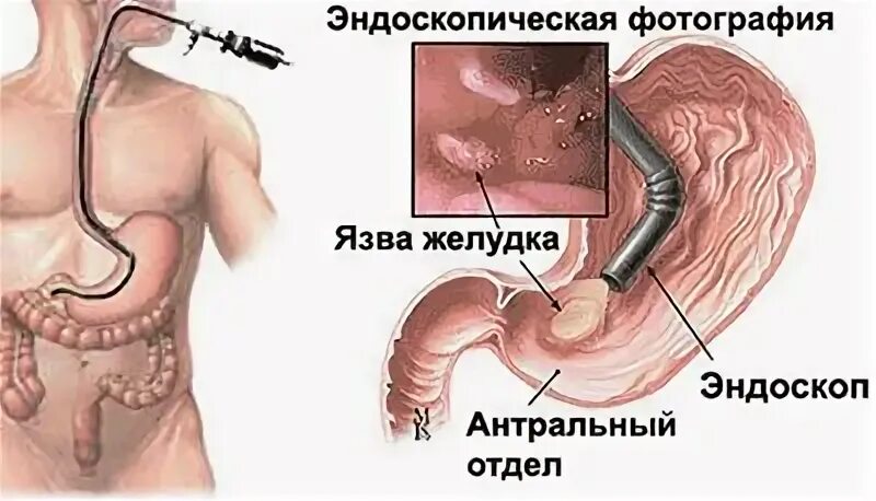 Симптомы хронического дуоденита. Гастродуоденит эрозивный бульбит. Язва желудка гастроскопия. Дуоденит 12 перстной кишки.