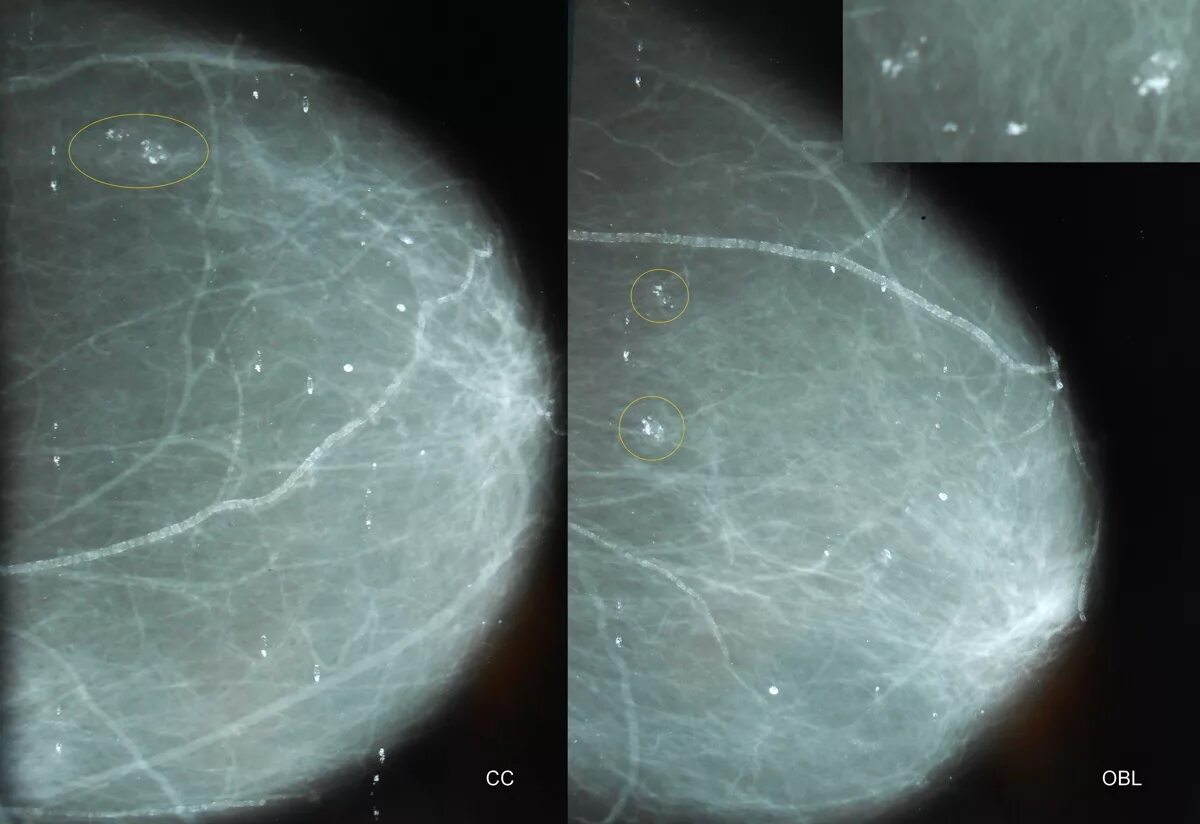 кальцинаты маммограмма. маммография кальцинаты что это значит. кальцификация мягких тканей молочной железы. маммография кальцинаты что это значит. сгруппированные микрокальцинаты в молочной железе что это такое.