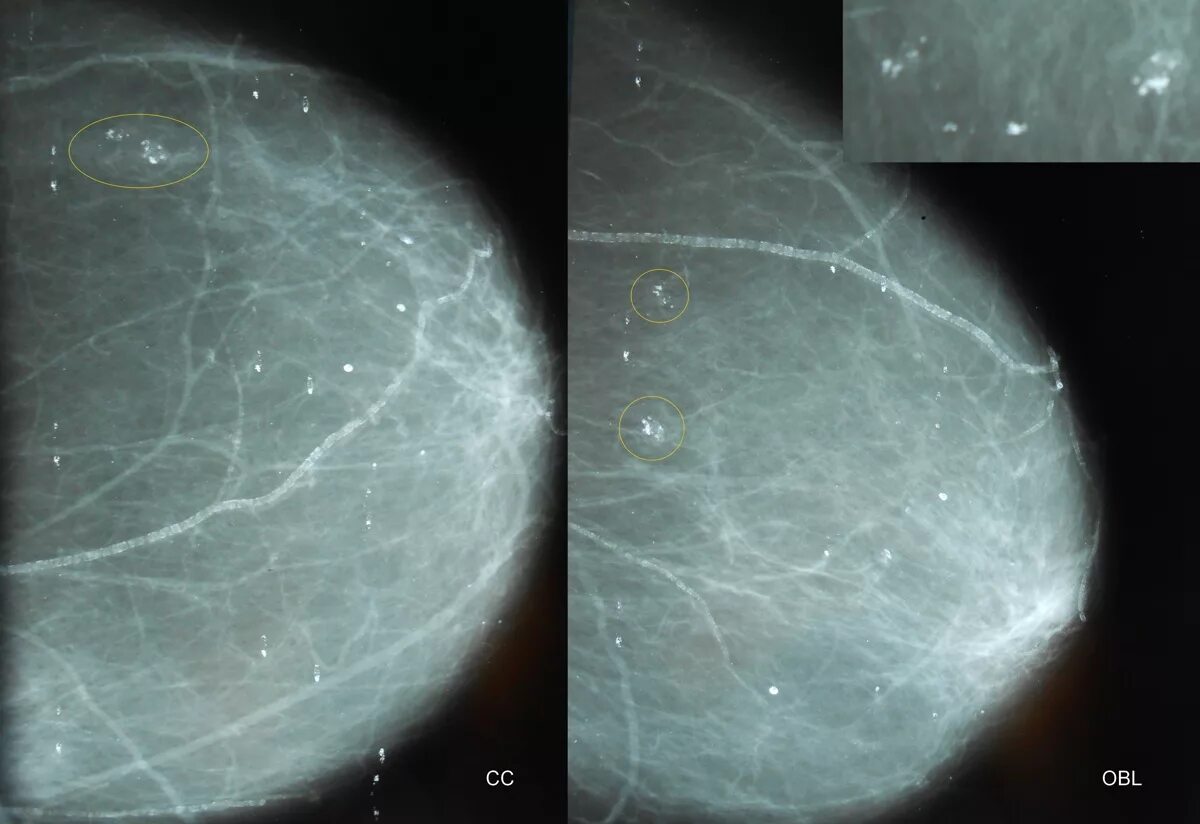 Множественные округлые. Кальцинаты на маммографии. Внутрипротоковые кальцинаты. Маммография кальцинаты доброкачественные.