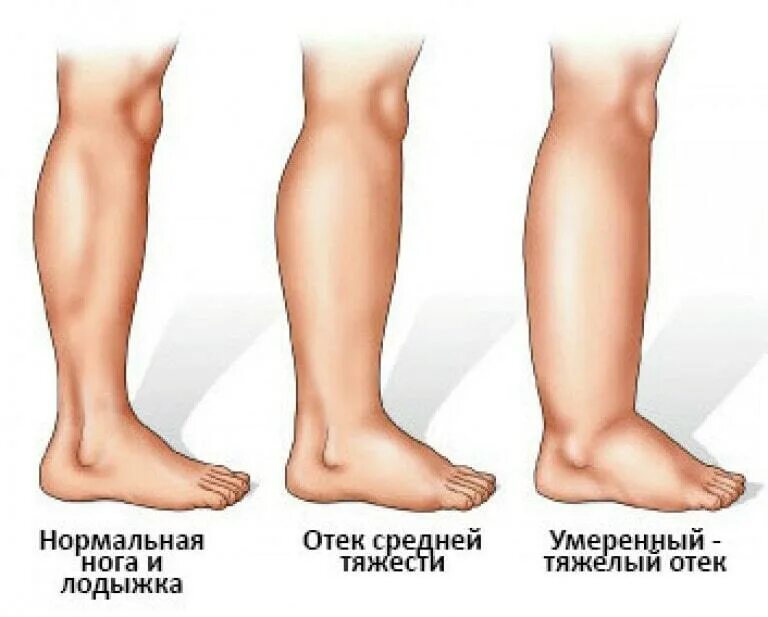 Как избавиться от отечности тела. Как избавиться от отечности тела
