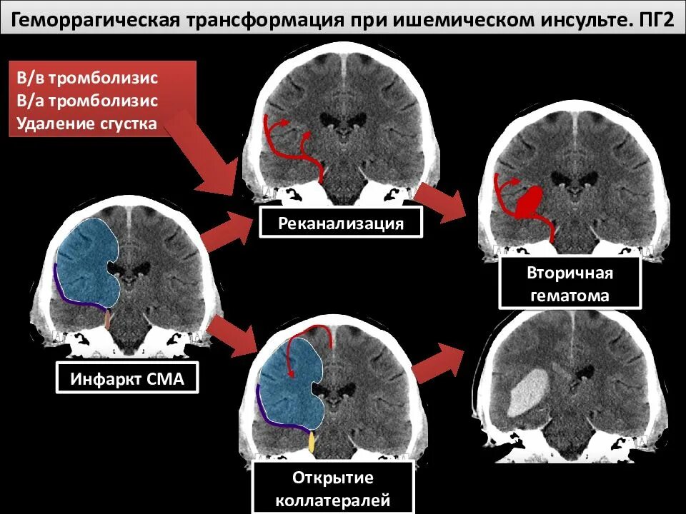 Ишемическом инсульте кровоизлияние. Кт при ишемическом и геморрагическом инсульте. стадии онмк мрт. кт картина онмк ишемический инсульт. геморрагическая трансформация ишемического инсульта типы на кт.