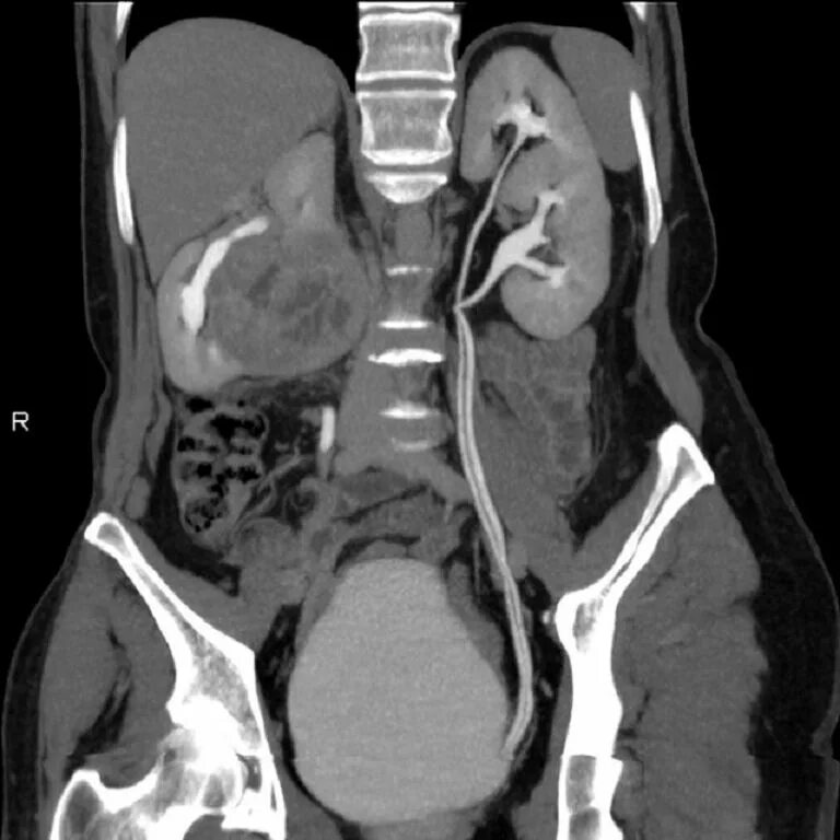Компьютерная томография почек с контрастированием. Внутривенная экскреторная урография. Контрастирование почек. Компьютерная томография поче. Кт с контрастированием почек онкология.