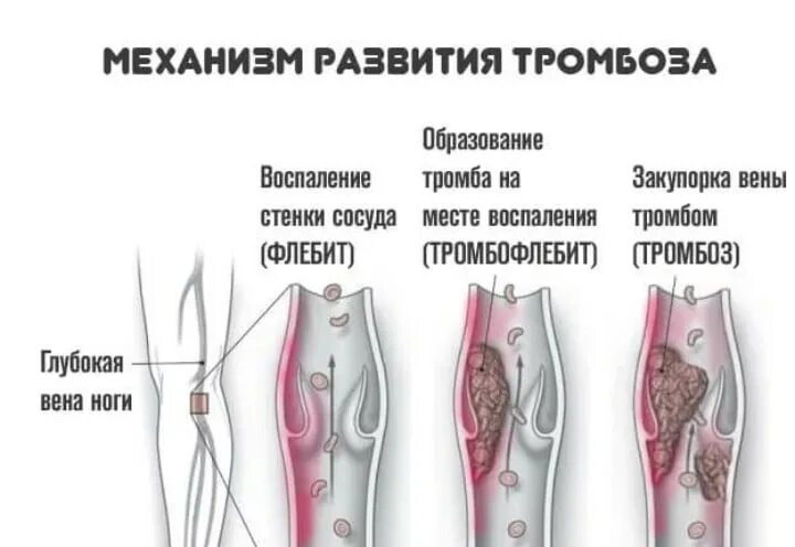 Лечение тромбофлебита поверхностных вен в Москве: цены, фото до и после, отзывы 