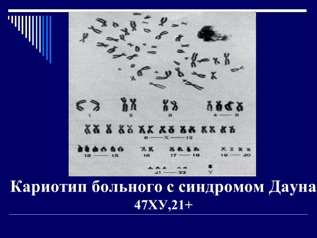 Кариотип больного человека. Синдром клайнфельтера кариотип. Моносомия по хромосоме 20. Кариотип больного с синдромом клайнфельтера. Кариограмма шерешевского тернера.