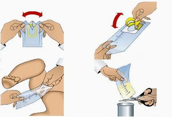 Как правильно одеть мочесборник для новорожденных. Мочесборник для новорожденных мальчиков как одевать. Как правильно приклеить мочеприемник девочке 1. Как использовать мочеприемник для мальчиков грудничков фото.