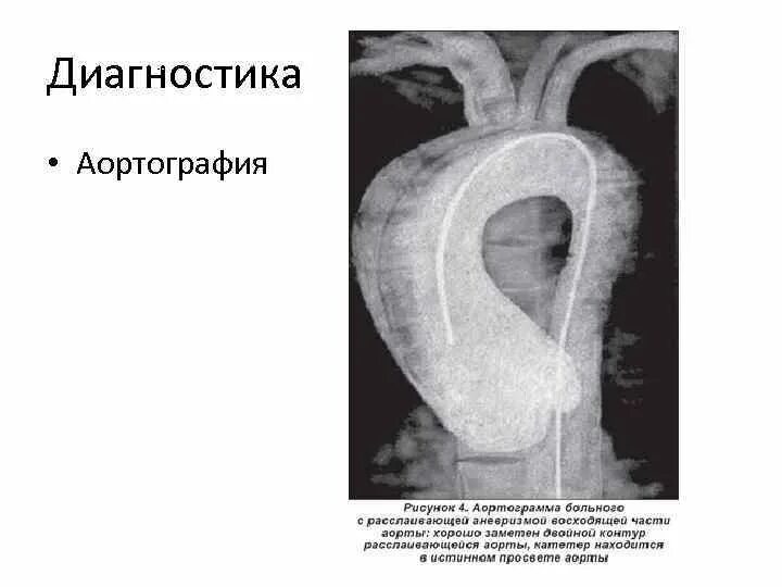 Расслаивающаяся аневризма аорты. Расслаивающая аневризма аорты рентген. расслоение аневризмы аорты на рентгене. расслаивающая аневризма аорты аортография. расслаивающая аневризма восходящего отдела аорты.