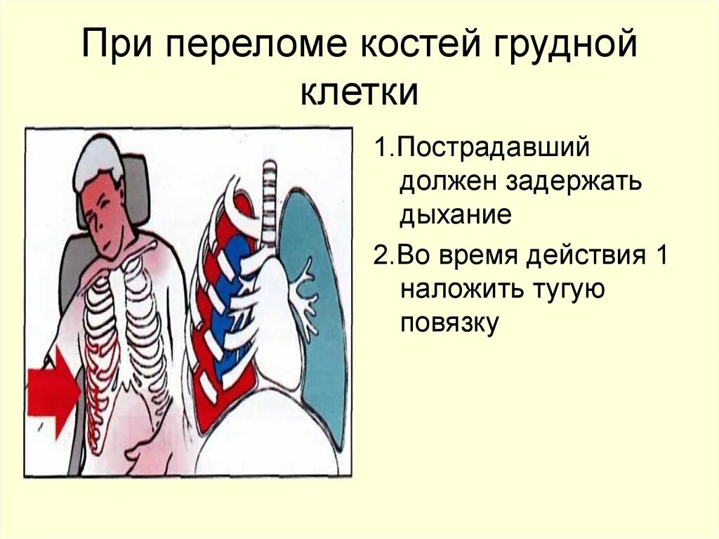 Переломы костей грудной клетки