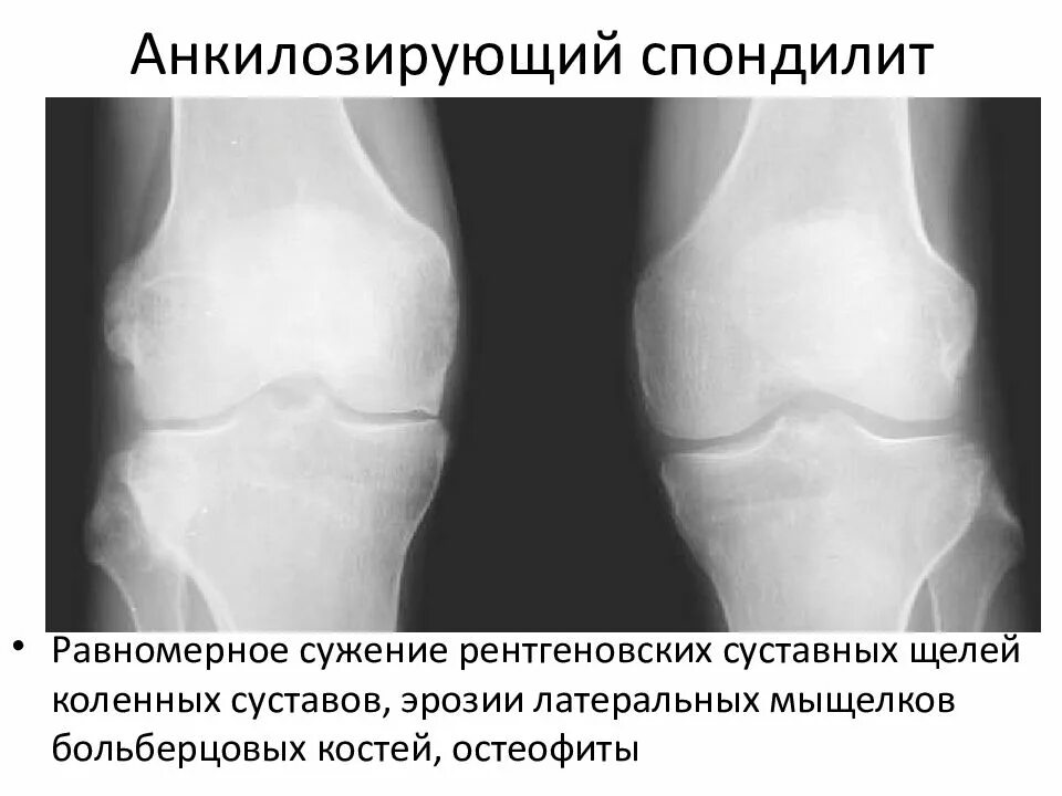 Болезнь анкилозирующий спондилит. Анкилозирующий спондилит бехтерева. анкилозирующий спондилит болезнь бехтерева. анкилозирующий спондилит коленного сустава. болезнь бехтерева коленного сустава рентген.