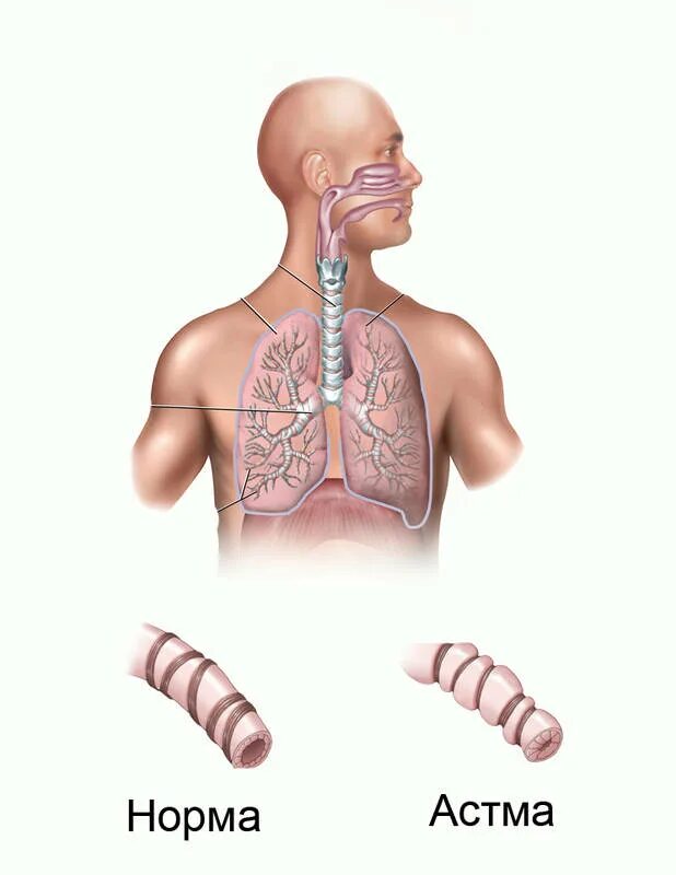 Bronchial asthma. Бронхиальная астма. Бронхиальная астма патология.