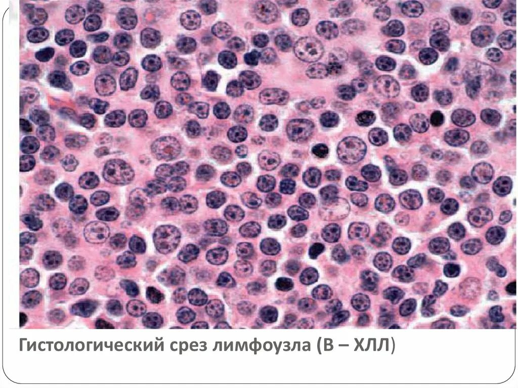 Лимфа соединительная ткань. Лимфолейкоз гистология лимфатического узла. Кровь и лимфа гистология. Хронический лимфолейкоз в лимфатическом узле микропрепарат. Жидкость в лимфоузле