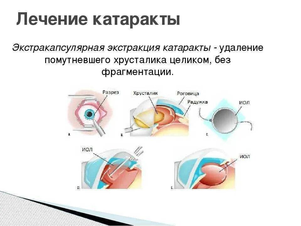 Катаракта схема глаза. Интракапсулярная и экстракапсулярная экстракция катаракты. К современным методам удаления катаракты относят. Катаракта экстракапсулярная экстракция. Глаукома латынь