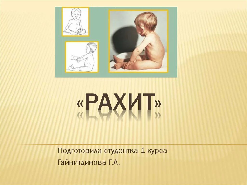 Рахит презентация