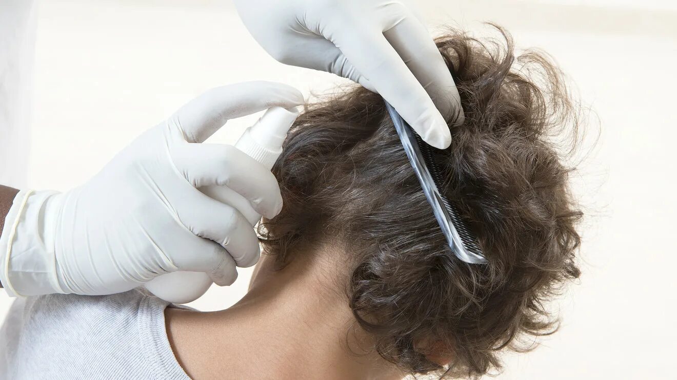 Как вылечить вшей. Педикулез вычесывание. Педикулез от вшей и гнид. Как вылечить вшей. Обработка от вшей.