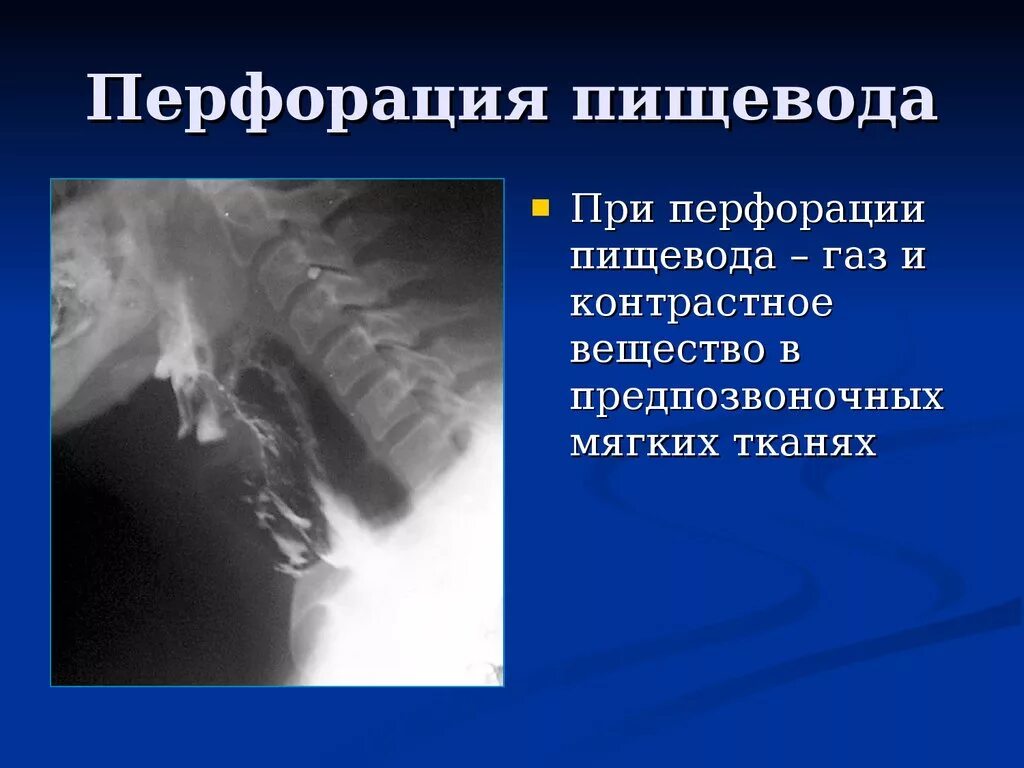 Перфорация пищевода подкожная эмфизема. Перфорация пищевода контрастное вещество. Медиастинит вследствие перфорации пищевода. Перфорация пищевода рентгенограмма. Синдром пищевода