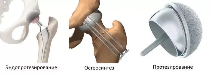 Операция при переломе шейки бедра в пожилом. Перелом шейки бедра у пожилых. Тазобедренный сустав перелом шейки бедра. Перелом шейки бедра операция эндопротез. Операция при переломе шейки бедра эндопротез.