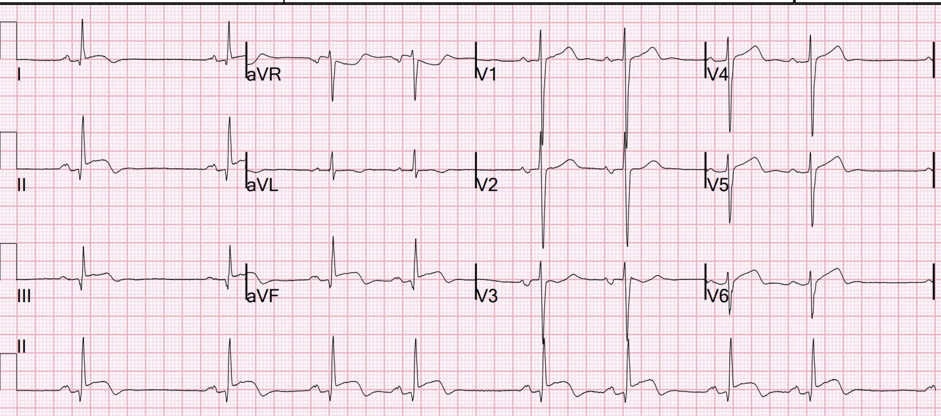 ECG km 122. Комплекс QRS типа QS. Abnormal QRS. Неправильной формы QRS.