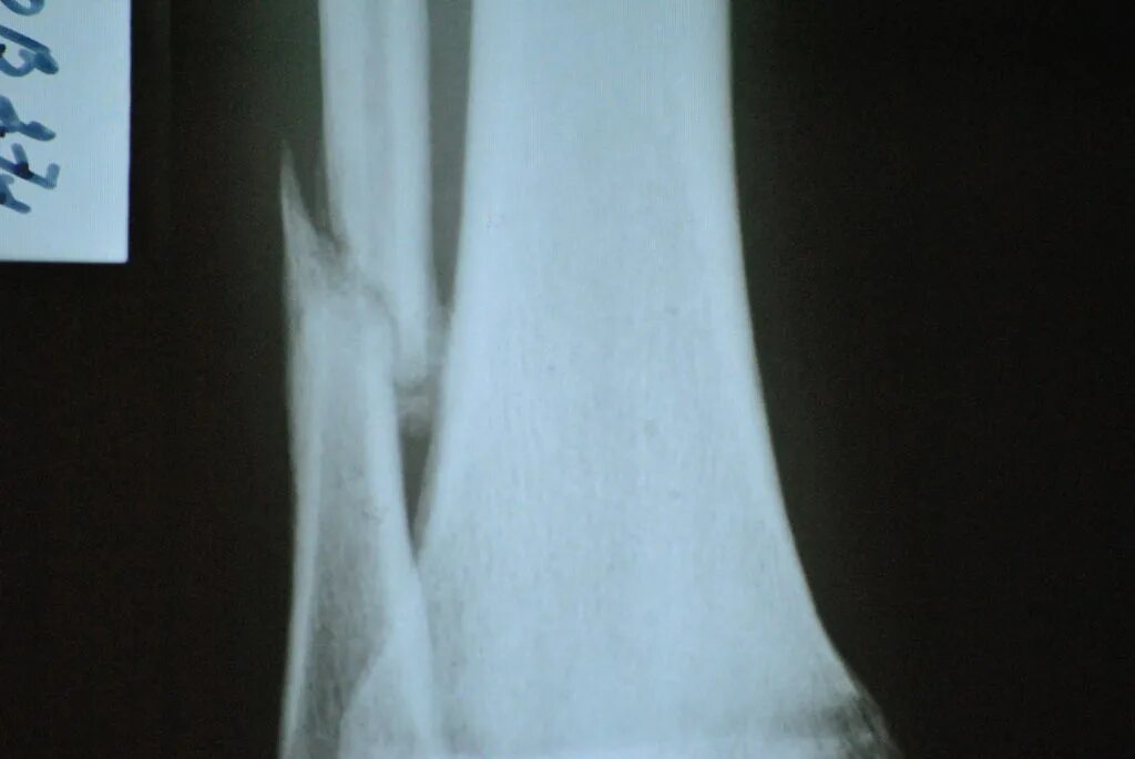 Малая берцовая кость смещение. Малая берцовая кость смещение. Перелом малой и большой берцовой кости. Перелом малой берцовой кости. Перелом малой берцовой кости.