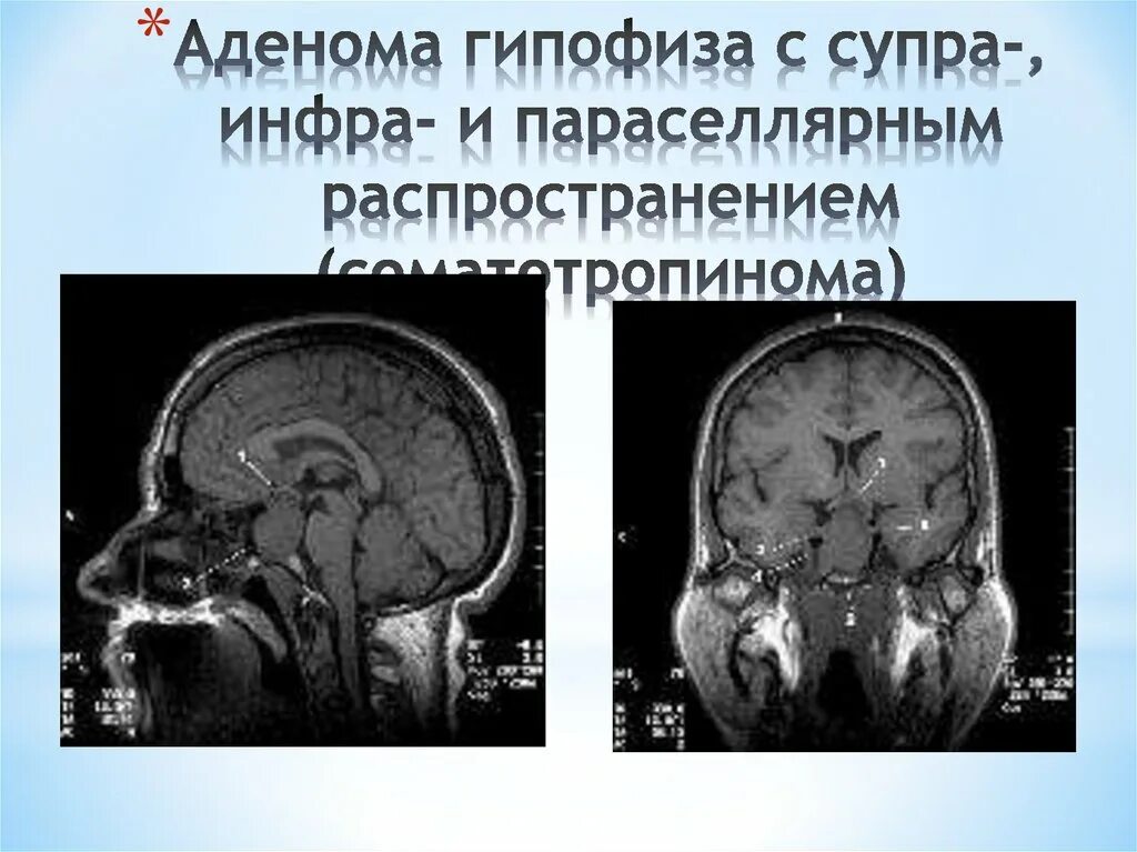 Опухоль гипофиза. Эндоселлярная аденома гипофиза. Эндоселлярный рост аденомы гипофиза. Соматотропинома. Кт гипофиза.