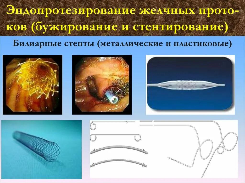 Стент желчного протока