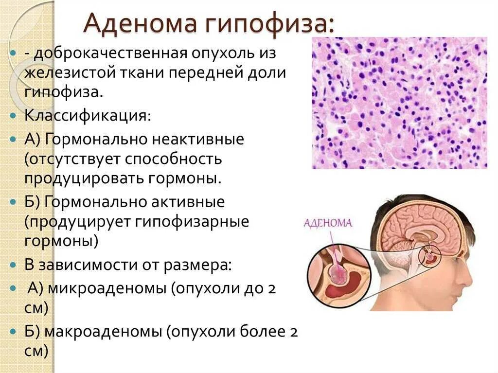 После операции аденомы гипофиза. Аденома гипофиза гормонально активная. Базофильная аденома гипофиза микропрепарат. Аденома гипофиза гистология. Лактотропная аденома гипофиза.