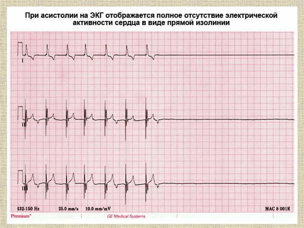 Асистолия сердца это. Асистолия желудочков на ЭКГ. Асистолия линия на ЭКГ. Асистолия и фибрилляция на ЭКГ. Асистолия изменения на ЭКГ.