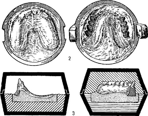 Способы загипсовки моделей в кювету. Обратный метод гипсовки в кювету. Прямой метод гипсовки в кювету. Методы гипсовки протеза в кювету.