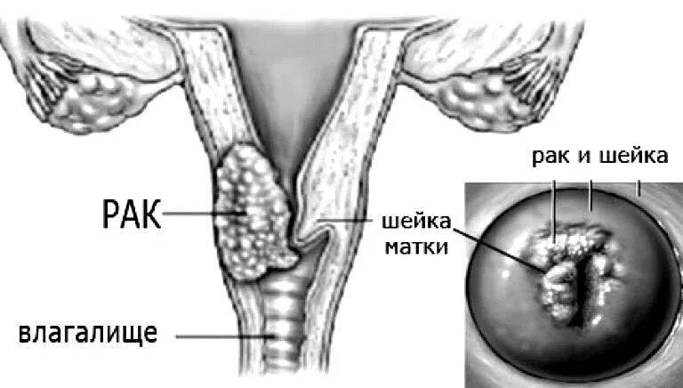 Рецидив после рака матки