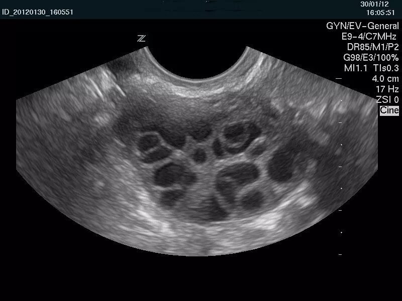 УЗИ яичников доминантный фолликул. Фолликулометрия УЗИ доминантный фолликул. Мультифолликулярные яичники на УЗИ.