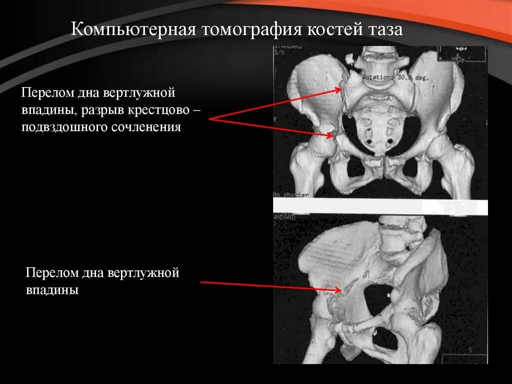 Перелом вертлужной впадины и подвздошной кости таза - Рентген на дому