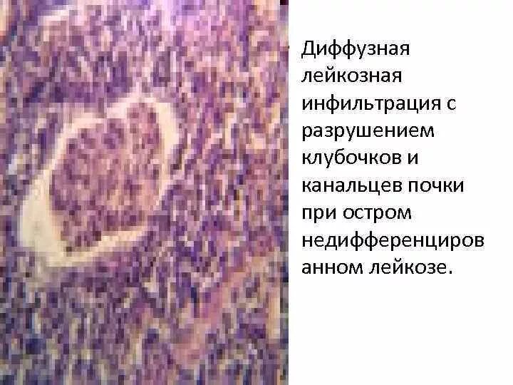 Диффузная лимфоцитарная инфильтрация. Печень при хроническом лимфолейкозе макропрепарат. почка при миелобластном лейкозе микропрепарат. лейкозная инфильтрация почки. острый лейкоз почек макропрепарат.