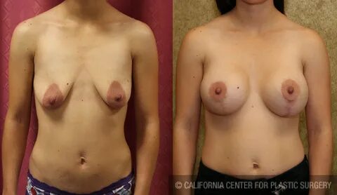 Full Breast Lift Before & After Patient #6930.