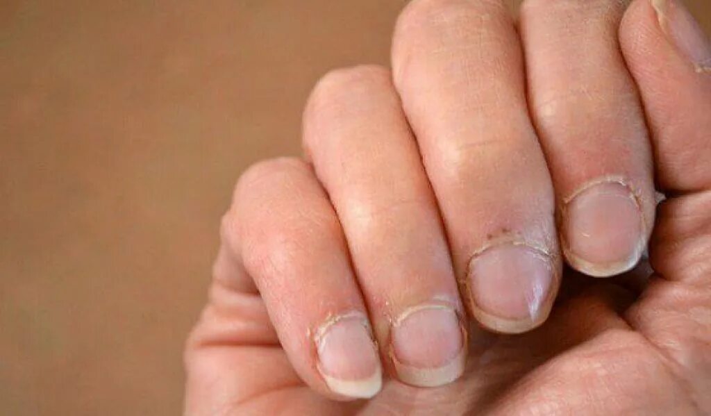 Тонкие ногти. Почему плохие ногти на руках. Ломкость и слоение ногтей. Почему плохие ногти на руках. Тонкие ногти.