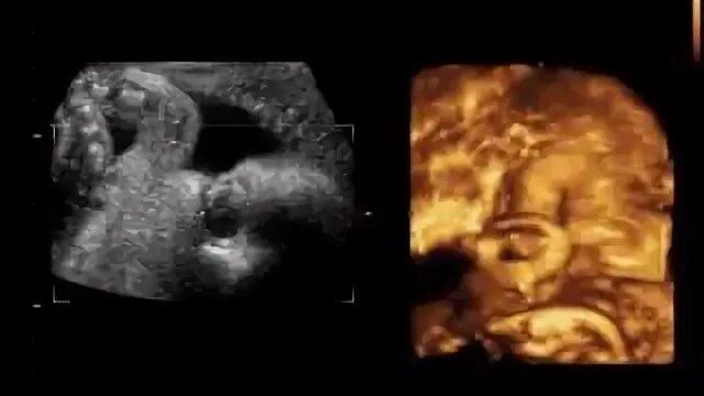 16 неделя можно ли узнать пол ребенка. 16 неделя можно ли узнать пол ребенка