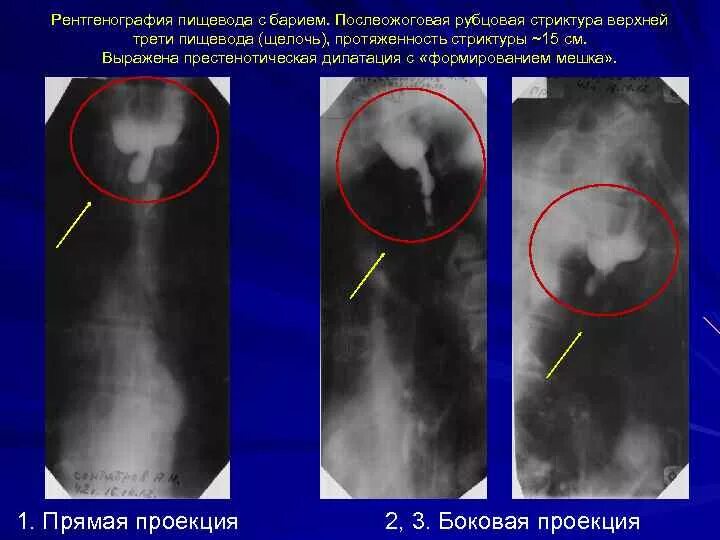 Рубцовые сужения пищевода